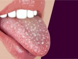 problemy w jamie ustnej